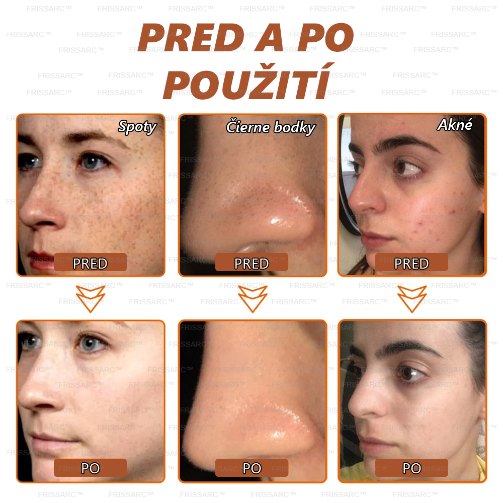 💟FRISSARC™ bieliaca a škvrny odstraňujúca pleťová maska –🍀Prírodné zložky trvalo odstraňujú pigmentové škvrny, starecké škvrny, pehy a slnečné škvrny.