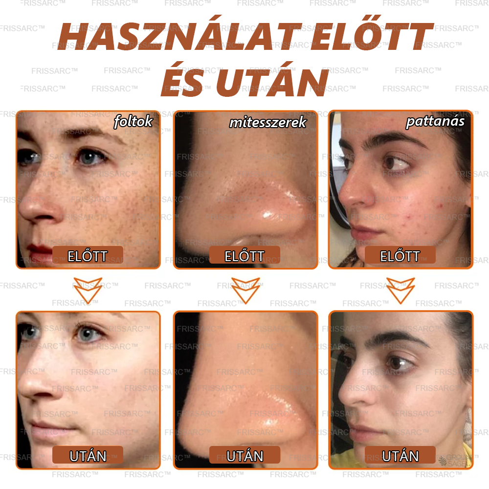 FRISSARC™ fehérítő és folteltávolító arcmaszk👨🔬A HUNCRO bőrgyógyász szakértői csapata által kifejlesztve