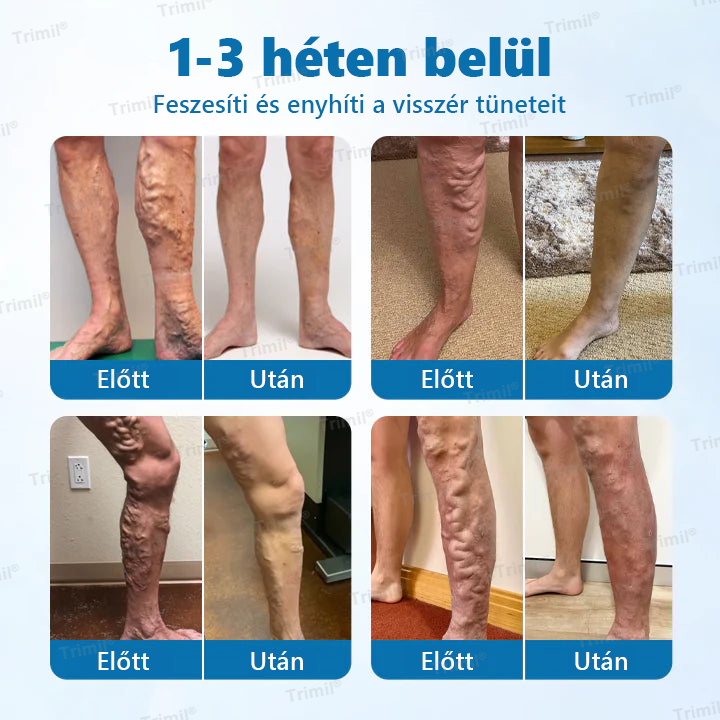 Trimil® VeinGuard Gyógynövényes Spray — 🔥Klinikailag bizonyított, hogy mindössze 7 nap alatt megszünteti a visszereket!