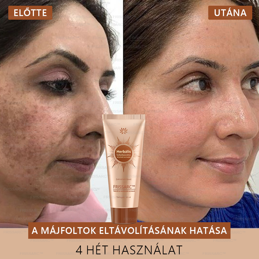 FRISSARC™ fehérítő és folteltávolító arcmaszk –👩⚕️Természetes összetevők tartósan eltüntetik a foltokat, szeplőket és napfoltokat.