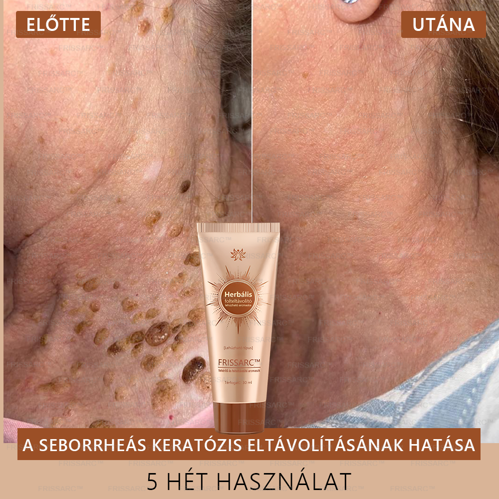 FRISSARC™ fehérítő és folteltávolító arcmaszk –👩⚕️Természetes összetevők tartósan eltüntetik a foltokat, szeplőket és napfoltokat.