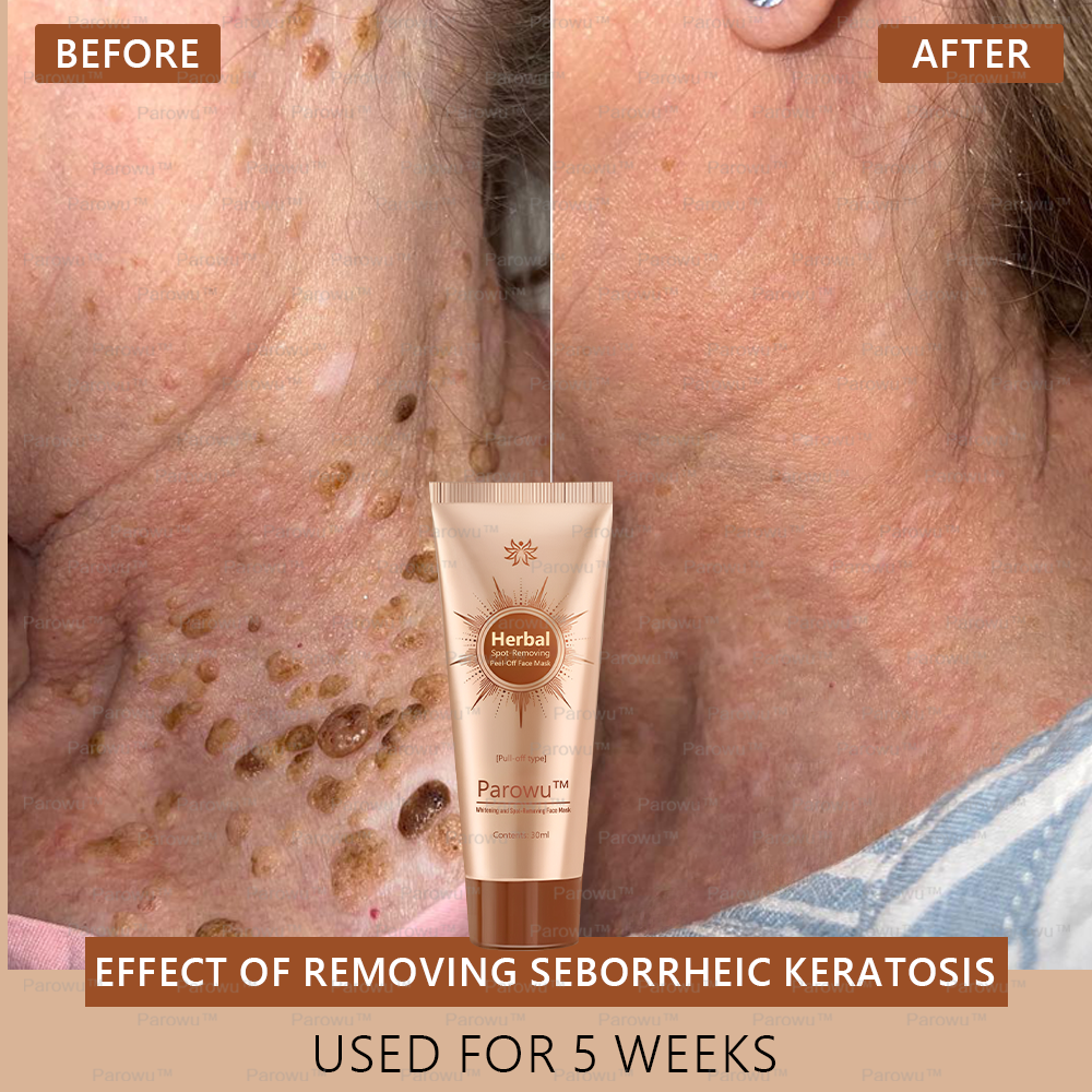 🏵️🏵️ Parowu™ Whitening and Spot-Removing Face Mask Suitable for face and body – 👩⚕️ Natural ingredients permanently remove age spots, freckles, sun spots, and liver spots.