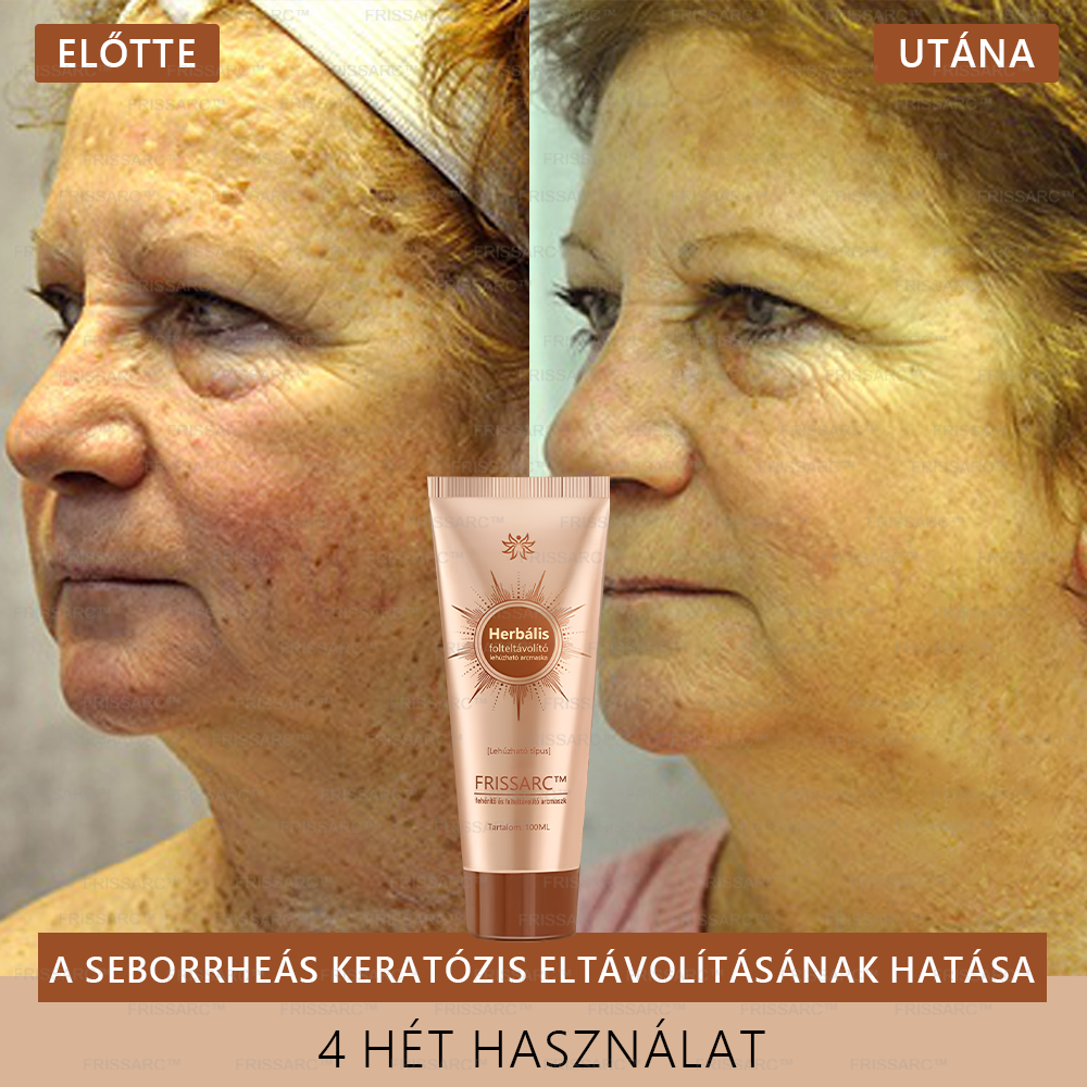 FRISSARC™ fehérítő és folteltávolító arcmaszk –👩⚕️Természetes összetevők tartósan eltüntetik a foltokat, szeplőket és napfoltokat.