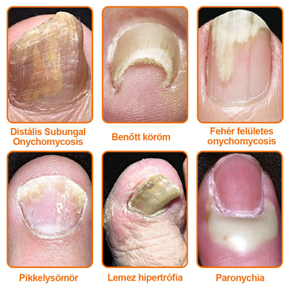 🐝【✨Hivatalos Üzlet✨】KörömVital™ Méhméreg Baktériumölő Körömkezelő Szérum (👨‍⚕️MSZ AJÁNLJA)