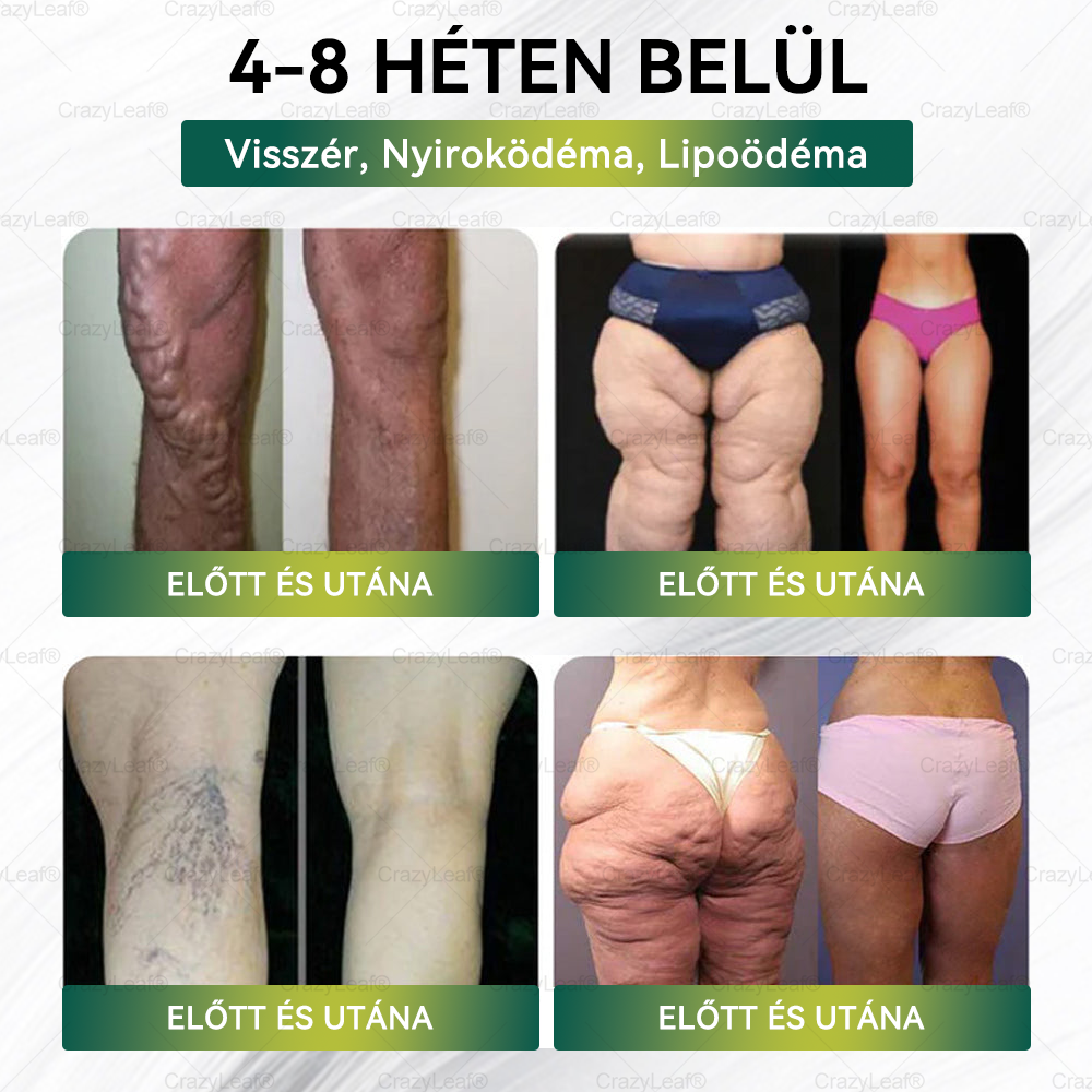 ✨✨│Hivatalos webáruház│🌿 CrazyLeaf® SMGT-GLP-1 Nano Mikrotűs Tapasz 👉Természetes segítség túlsúly, fáradtság, bőr- és ízületi problémák ellen.ermészetes segítség túlsúly, fáradtság, bőr- és ízületi problémák ellen.