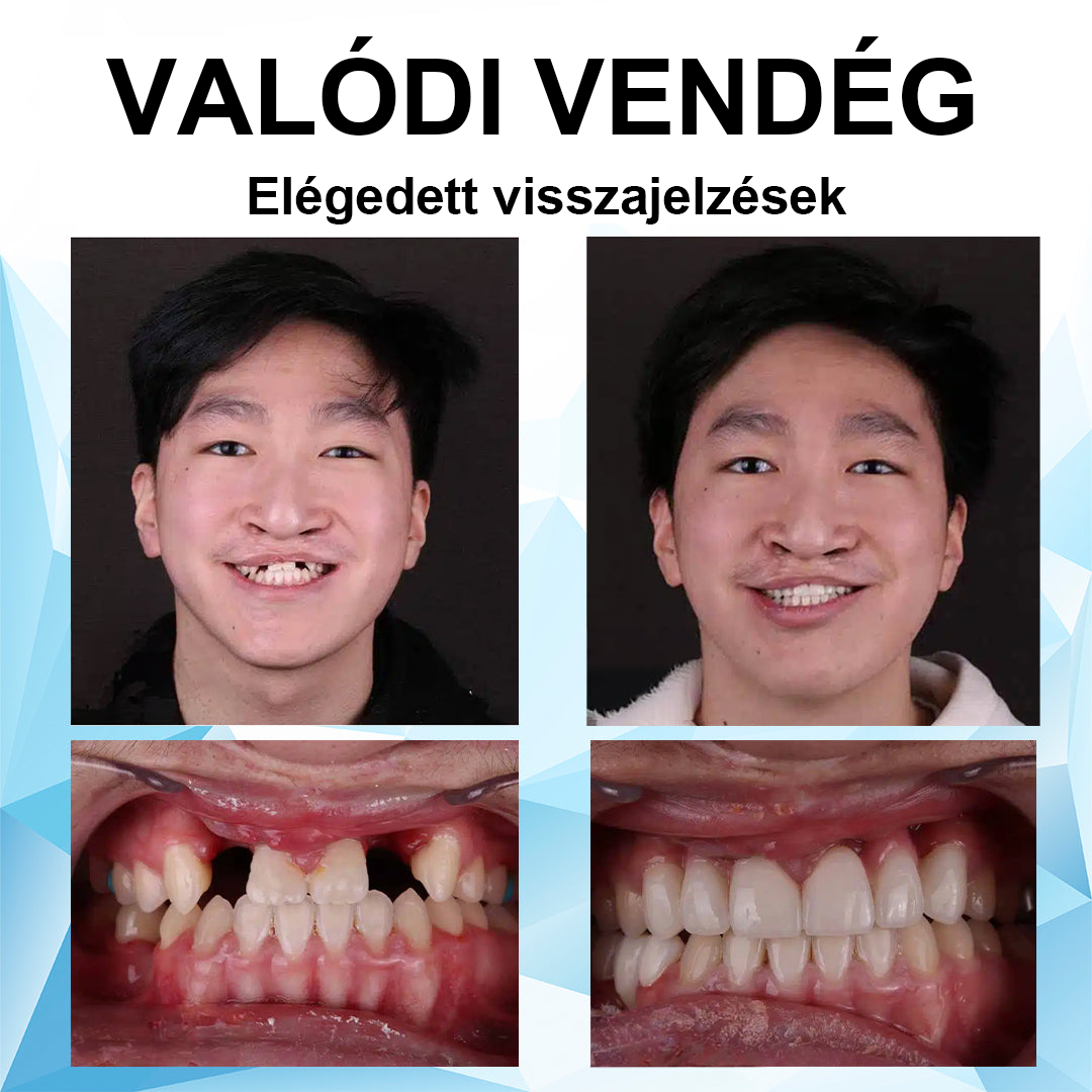 SzépFog™ 🦷Szilikon műfogsorbetét készlet🦷 (⏰60% kedvezmény korlátozott ideig, ma ingyenes szállítás!⏰)