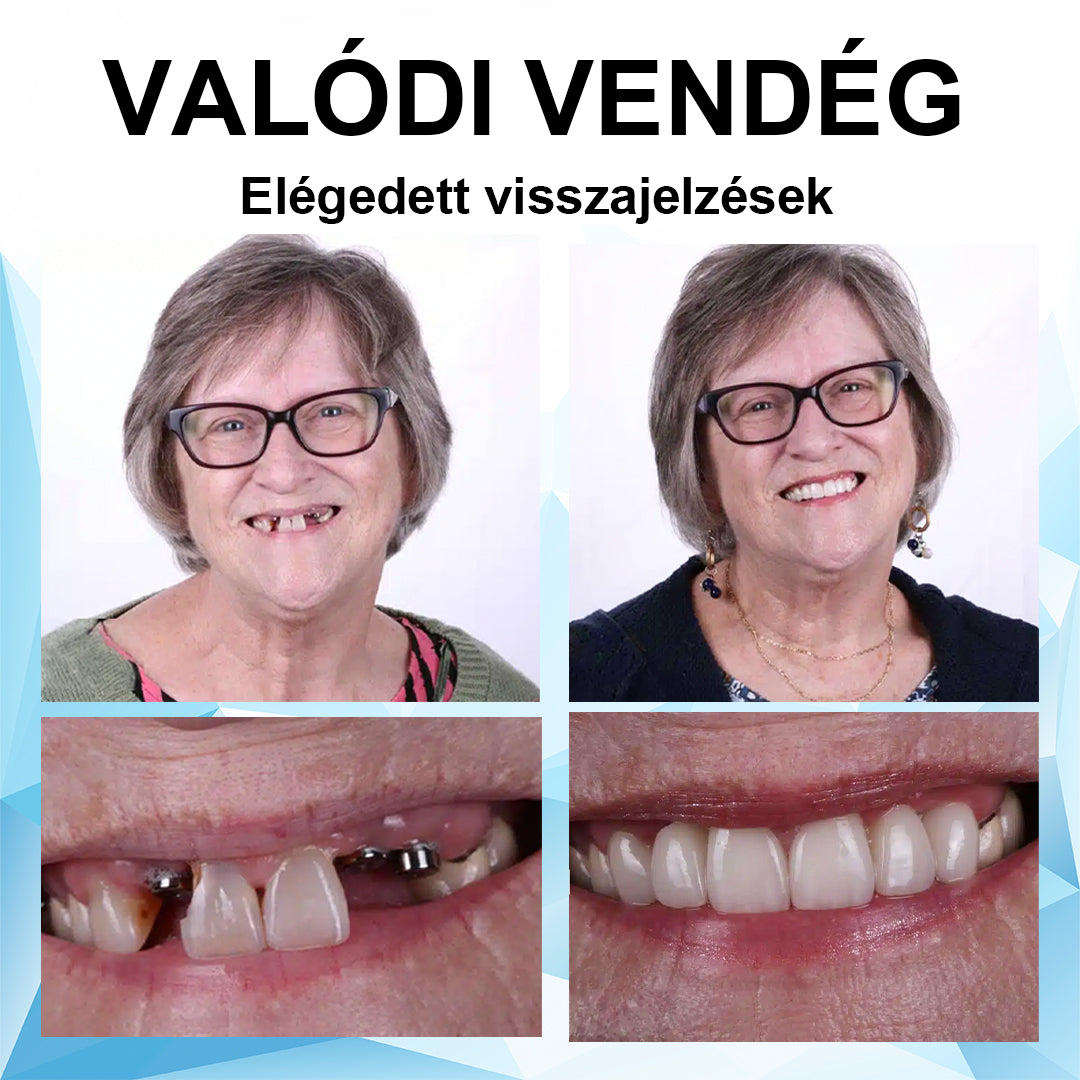 SzépFog™ Szilikon műfogsorbetét készlet🦷 (⏰60% kedvezmény korlátozott ideig, ma ingyenes szállítás!⏰)